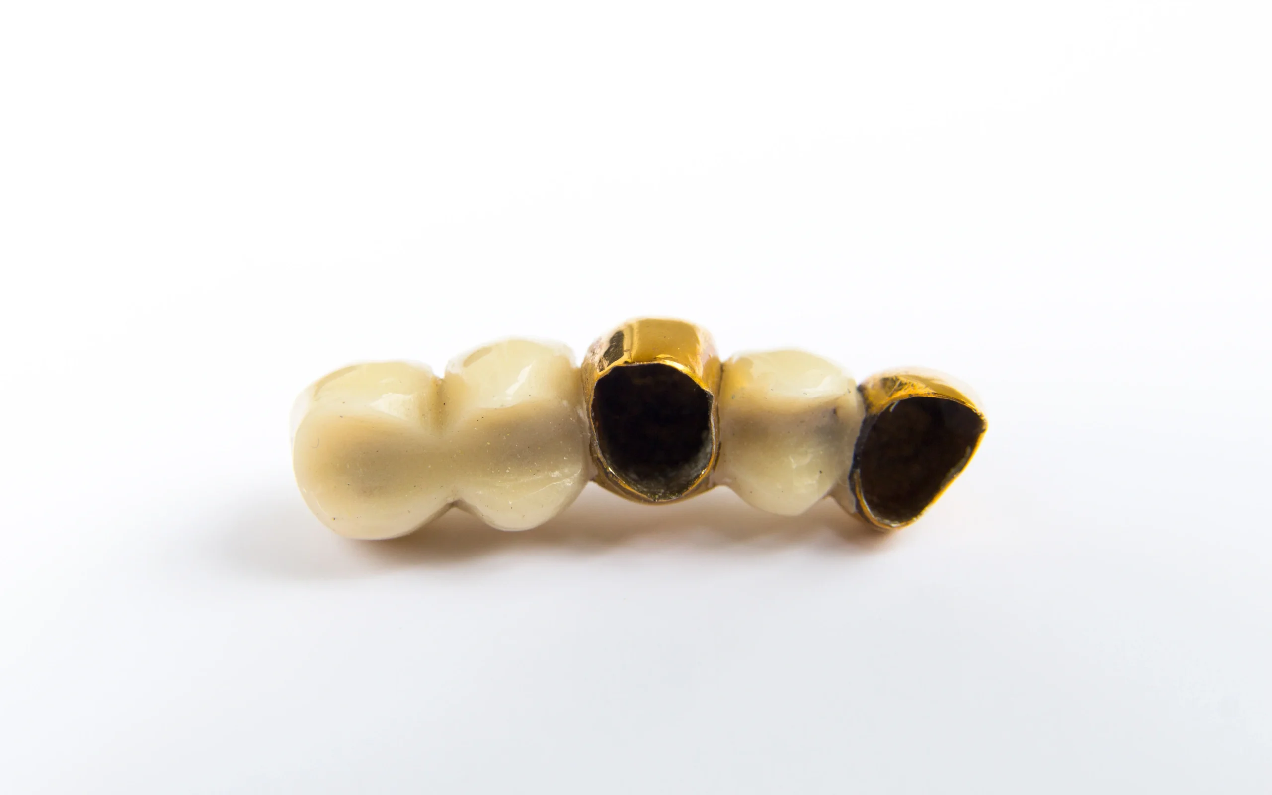 A dental bridge featuring 2 gold tooth caps shown from the bottom