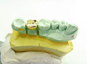 Dental gold crown being made