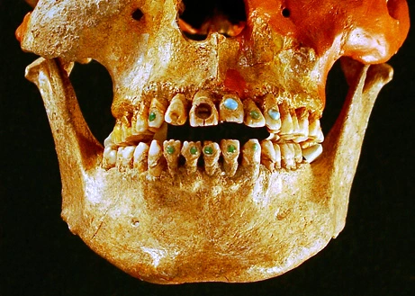 Mayan jeweled dental inlay