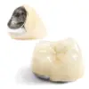 Dental porcelain fused metal (PFM)