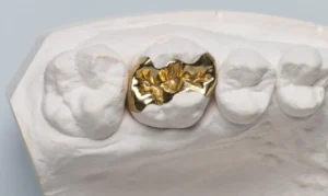 Gold dental onlay on a dental mold
